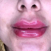 خدمات ژل و بوتاکس|خدمات آرایشگری و زیبایی|ساری, |دیوار