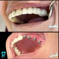 هنوز اقدام به رفع بی دندانی نکردی بخاطر قیمتشه