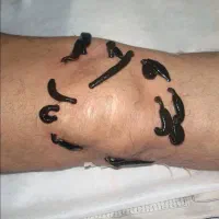 حجامت بادکش وزالودرمانی انجام میشود