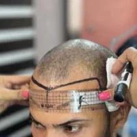 کاشت مو تخصصی در شیراز( با تخفیف 10 تومنی)