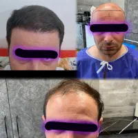 کاشت مو فول تراکم شرایط اقساطی