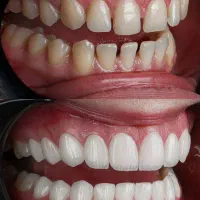 دندانپزشکی ایمپلنت تخصصی باشرایط اقساطی فقط۱۳ تومن