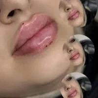 تزریق ژل کل صورت۱۰ سی سی  فقط۸۹۰۰