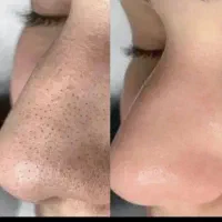 اپلاسیون فیشیال پدیکور