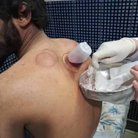 حجامت،زالو درمانی،بادکش گرم