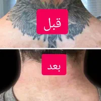 مرکز ریمو،پاک کردن،ریموو تتو ابرو با لیزر در شیراز