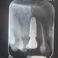 ایمپلنت با شرایط ویژه