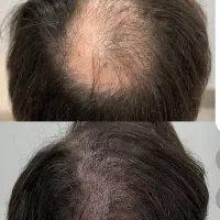 میکرواسکالپ تخصصی با جدیدترین متدvip|خدمات آرایشگری و زیبایی|مشهد, گوهرشاد|دیوار