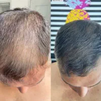 موهای جلوی سرتان کم‌پشت شده
