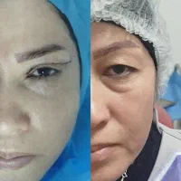 جراحی بلفارو پلاستی ساکشن غبغب بوکال فت سانترال .|خدمات آرایشگری و زیبایی|کرج, فاز ۳ مهرشهر|دیوار