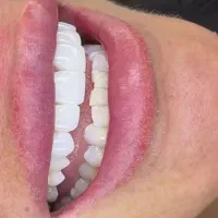 کامپوزیت ۸۰۰۰م با ضمانت ،عصب کشی و پرکردن از 2700