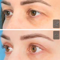 جشنواره تخفیف بلفاروپلاستی(جراحی پلک)