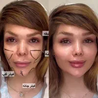 مدل کلینیک زیبایی  ژل  بوتاکس