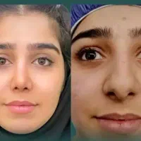 عمل بینی ترمیمی/گوشتی/بلفاروپلاستی/آفرویژه