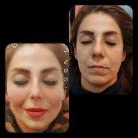آموزش و تزریق ژل و بوتاکس ومزو|خدمات آموزشی|شیراز, تندگویان|دیوار