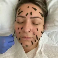 فصد،حجامت،طب سوزنی،زالودرمانی،سم زدایی بدن|خدمات آرایشگری و زیبایی|ارومیه, |دیوار