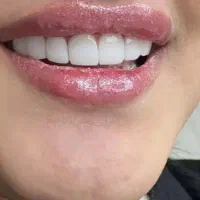 کامپوزیت فقط وفقط فکی۵ باشرایط اقساطی