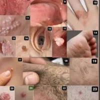 درمان زگیل تناسلی از ریشه