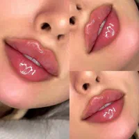 تزریق ژل لب،بوتاکس،زاویه سازی