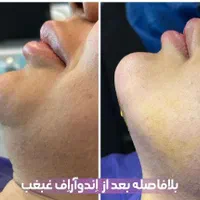 لیفت صورت و بدن با دستگاه اندو ار اف