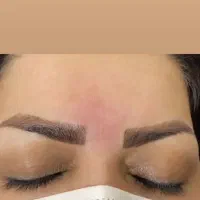 بوتاکس و ژل