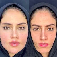 جشنواره باور نکردنی ویژه. ژل و بوتاکس.فیلر مزو ژل|خدمات آرایشگری و زیبایی|شیراز, سینما سعدی|دیوار