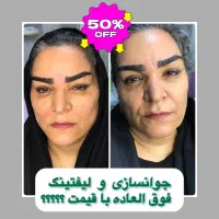 تزریق ژل لب بوتاکس کانتورینگ صورت جوانسازی لیفت|خدمات آرایشگری و زیبایی|تهران, صادقیه|دیوار