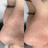 درماپلینیگ درما پاکسازی|خدمات آرایشگری و زیبایی|زابل, |دیوار