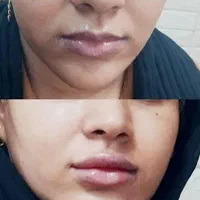 تزریق ژل لب.گونه.چانه.زاویه سازی فک.آنزیم بینی