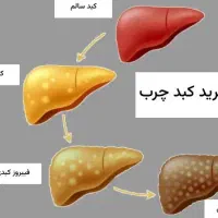 درمان کاملا گیاهی کبد چرب