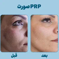 خال برداری، پی آر پی ،پرسینگ بوتاکس|خدمات آرایشگری و زیبایی|مشهد, موسوی قوچانی|دیوار