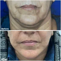 جراحی لیفت صورت در شیراز ماندگاری بالا+اقساط