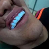 آف کامپوزیت دندان هر فک ۶ نیم میلیون