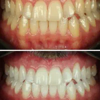 مدل خوش فیس برای بلیچینگ و سفیدکردن دندان|خدمات آرایشگری و زیبایی|تهران, دریاچه شهدای خلیج فارس|دیوار