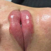 خدمات ژل و بوتاکس ، مزوتراپی سر و صورت|خدمات آرایشگری و زیبایی|شاهینشهر, فردوسی|دیوار