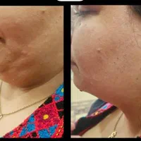 جشنواره تخفیف پی آر پی و ژل و بوتاکس|خدمات آرایشگری و زیبایی|شیراز, زرگری|دیوار