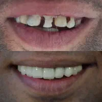 جشنواره دندانپزشکی (تمامی خدمات)|خدمات آرایشگری و زیبایی|اصفهان, لنبان|دیوار