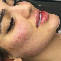 تخفیفات ژل وبوتاکس ومزوژل به مناسبت یلدا|خدمات آرایشگری و زیبایی|قم, زنبیل آباد|دیوار