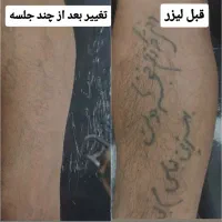 پاک کردن تاتو با دستگاه لیزر پیشرفته|خدمات آرایشگری و زیبایی|ماهدشت, |دیوار