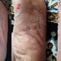 رفع مشکلات پوست و مو|آرایشی، بهداشتی، درمانی|بندر ترکمن, |دیوار