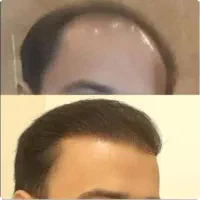 کاشت مو و ابرو تضمینی با مجوز یزد