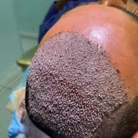 کاشت مو ، ریش ، ابرو|خدمات آرایشگری و زیبایی|شیراز, معالی‌آباد|دیوار
