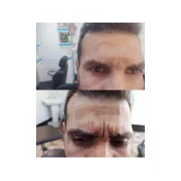 تزریق بوتاکس