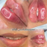 مرکز تخصصی تزریق فول فیس چربی و فیلر/لیفت با نخ|خدمات آرایشگری و زیبایی|مشهد, هنرستان|دیوار