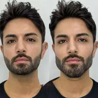 تزریق ژل فیلر و بوتاکس مزو ژل