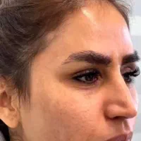 رفع لک وجوش رفع آفتاب سوختگی لک چین و چروک|آرایشی، بهداشتی، درمانی|کرج, گلدشت|دیوار
