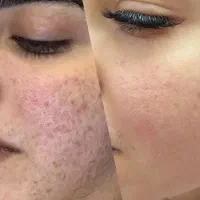 بوتاکس در منزل شما ،پاکسازی،برداشت خال و لک