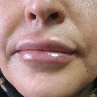 مدل تزریق ژل و بوتاکس و مزو تراپی و فیلر