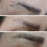 ریموو درمانی تتو های بدرنگ قدیمی|خدمات آرایشگری و زیبایی|الشتر, |دیوار