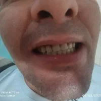 ساخت انواع دندان های مصنوعی متحرک و لثه ژله ای|آرایشی، بهداشتی، درمانی|شیراز, اصلاحنژاد|دیوار